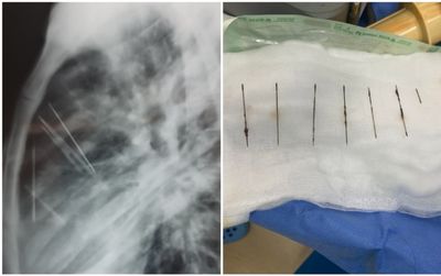 Nữ bệnh nhân có 7 cây kim gỉ sét nằm trong lồng ngực suốt 2 tháng được phẫu thuật lấy ra thành công