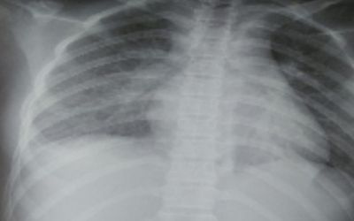 Sau 2 tuần khỏi Covid-19 bé gái đi học lại bình thường nhưng bất ngờ rơi vào nguy kịch