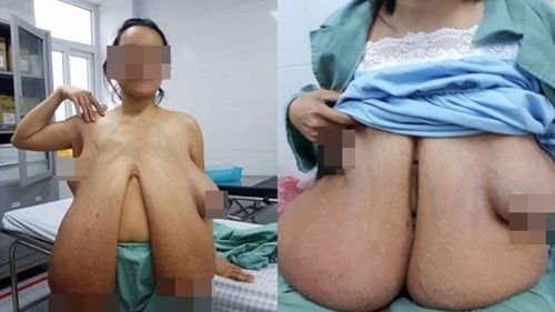 Người đàn bà có bộ ngực lớn bất thường ở VN: 'Tôi khổ lắm, chẳng làm được gì vì ngực nặng'