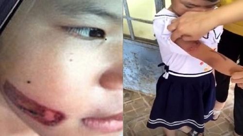 Khởi tố vụ bé gái 7 tuổi bị bạo hành bằng thanh sắt nóng