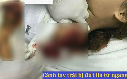 Chơi trốn tìm cùng bạn, bé gái bị máy cưa cắt đứt lìa cánh tay trái vĩnh viễn