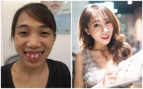 Nhờ phẫu thuật thẩm mỹ, 5 cô gái biến thành hot girl khiến dân mạng xôn xao