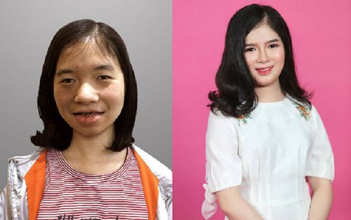 Cô gái bị gắn mác 'ma cà rồng',  suốt 18 năm không dám soi gương và hành trình 'lột xác' khiến nhiều người ngỡ ngàng