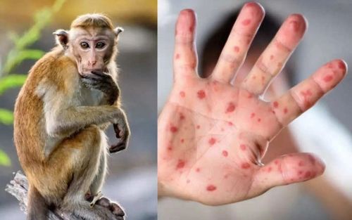 Khuyến cáo 6 biện pháp phòng chống bệnh đậu mùa khỉ mà ai cũng cần biết