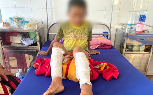Xót xa đôi chân bỏng của đứa trẻ bị bố say rượu chất rơm đốt