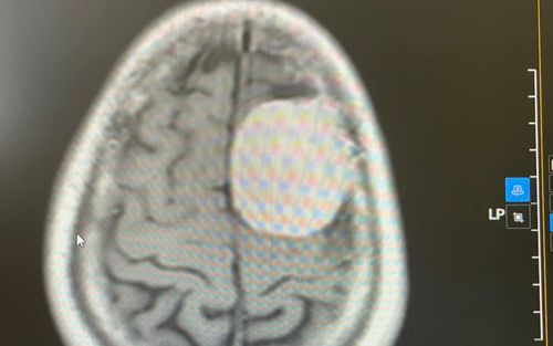Sau cơn đau đầu dữ dội, người đàn ông được bác sĩ phát hiện thứ này gây sốc